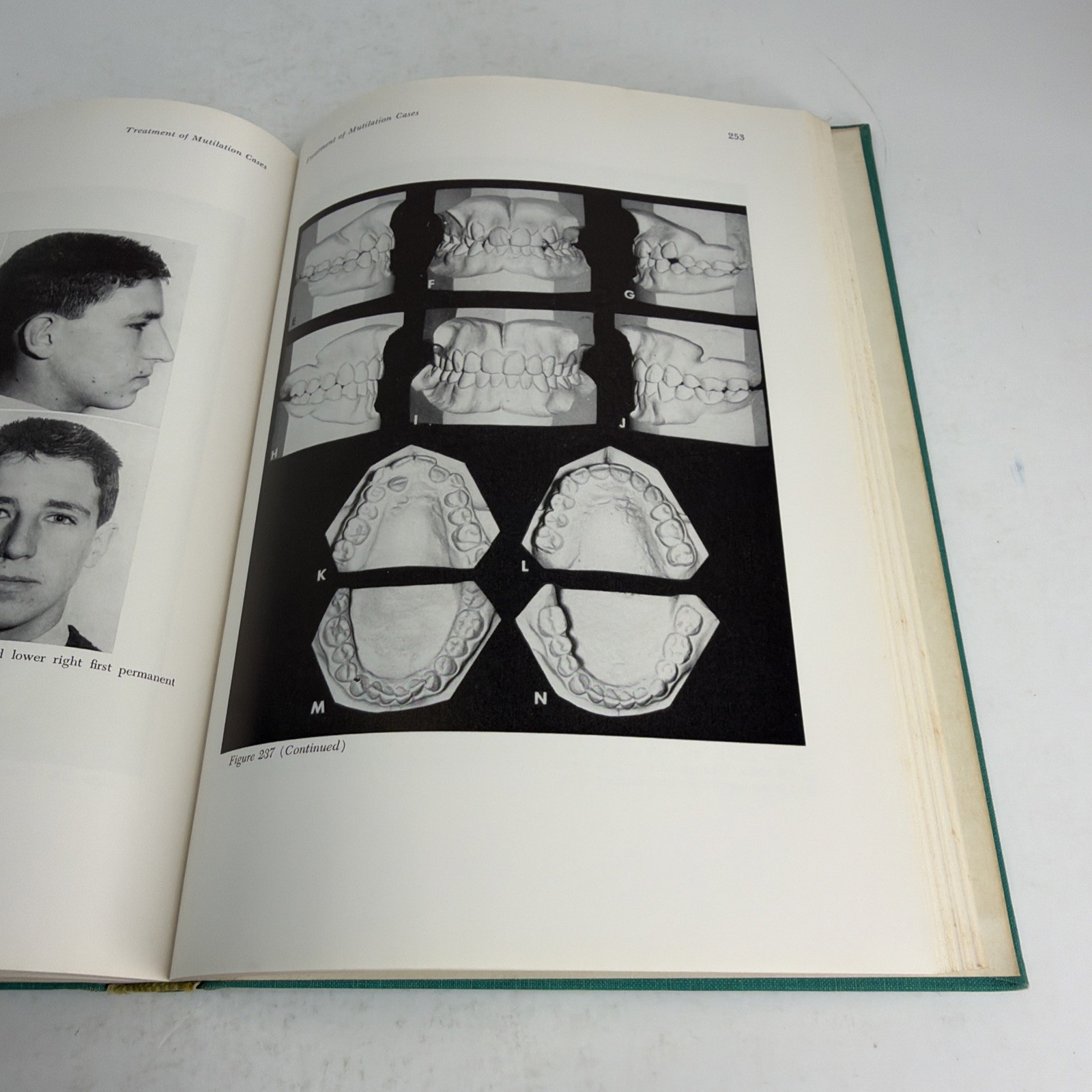 Begg Orthodontic Theory and Technique 1965 Hardcover by P. R. Begg
