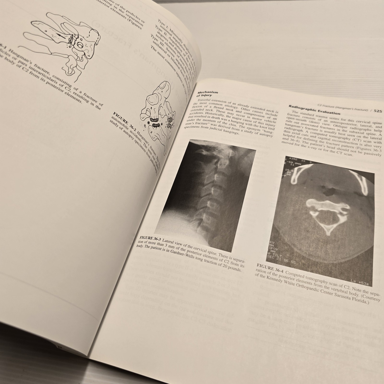 Treatment & Rehabilitation of Fractures Hoppenfeld Murthy Textbook Medical