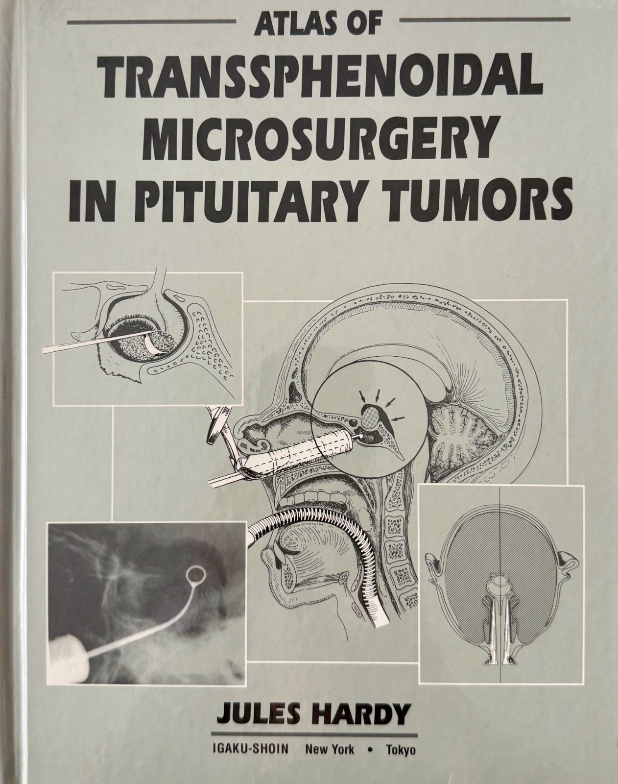 Atlas of Transsphenoidal Microsurgery in Pituitary Tumors by Jules Hardy 1st ed