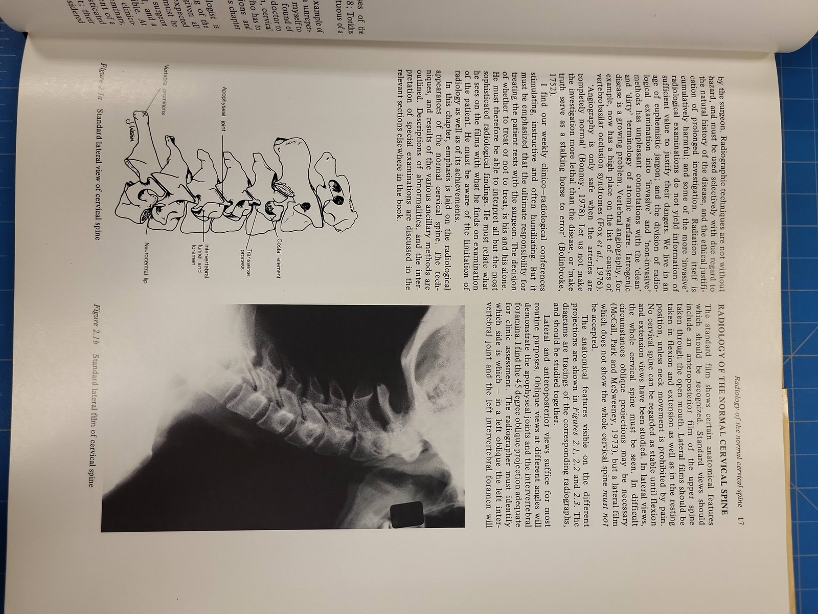 Butterworths Disorders Cervical Spine Eurig Jeffreys 1980 Orthopedic Surgery